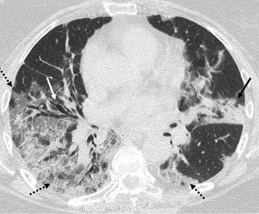 Daños en los pulmones: Tomografía computerizada del tórax de un paciente de 60 años, positivo en SARS-CoV-2. Las flechas marcan la posición de varias lesiones causadas por el virus