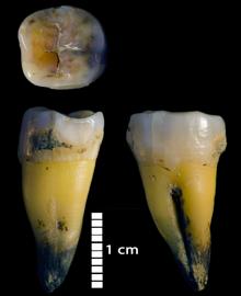 Segundo molar inferior de un humano moderno hallado en la cueva de Bacho Kiro. Los datos indican que el individuo tuvo un antepasado neandertal menos de seis generaciones antes de su nacimiento