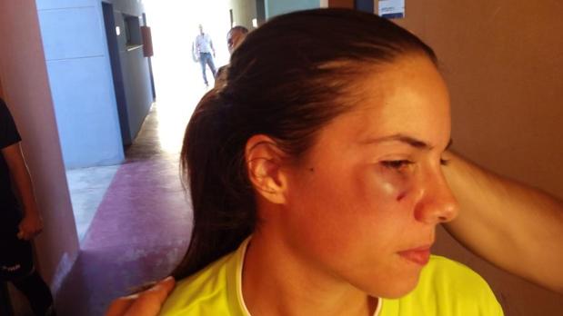 Una jugadora del Manchego acabó con el ojo hinchado y amoratado