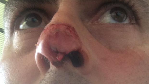 Arrancan de un mordisco un trozo de nariz a un jugador del Son Verí mallorquín