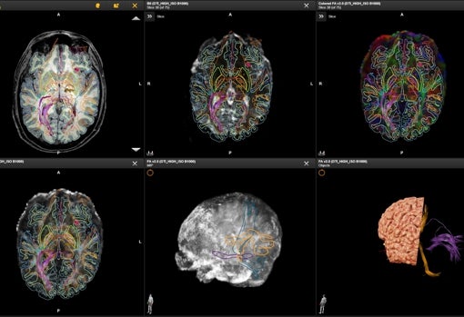 Estudio preliminar de segmentación cerebral para analizar el procesamiento de las distintas áreas del cerebro
