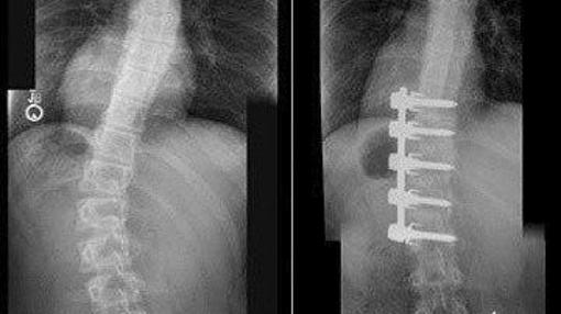 Curvatura de la columna vertebral subsanada en el tratamiento de la escoliosis