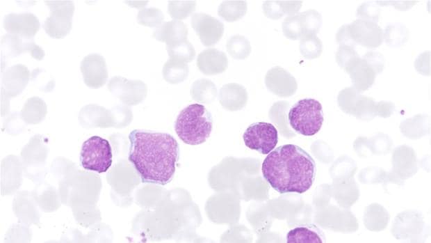 Ejemplo de leuicemia aguda tipo T (células cancerosas teñidas de violeta)