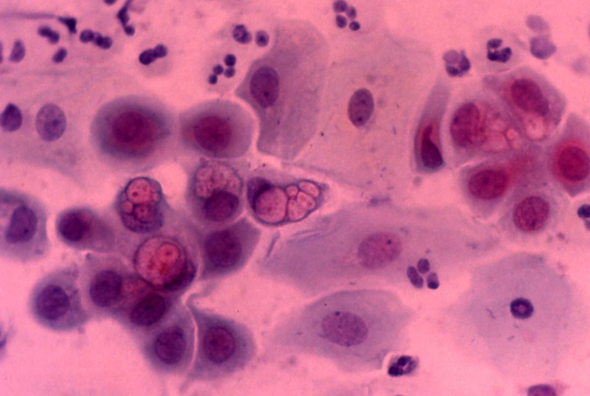 Imagen microscópica de esperma infectado con clamidia