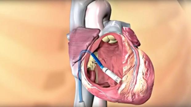 Implantan, por primera vez, un marcapasos sin cables a un menor de edad