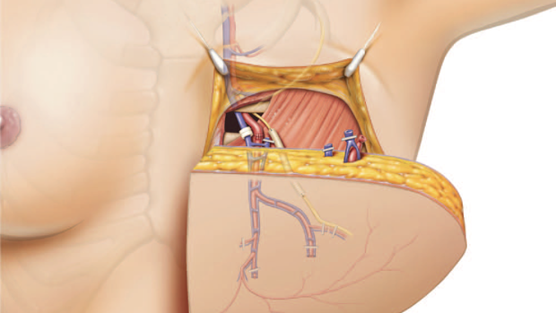 Una nueva técnica permite recuperar la sensibilidad en las mamas reconstruidas tras un cáncer