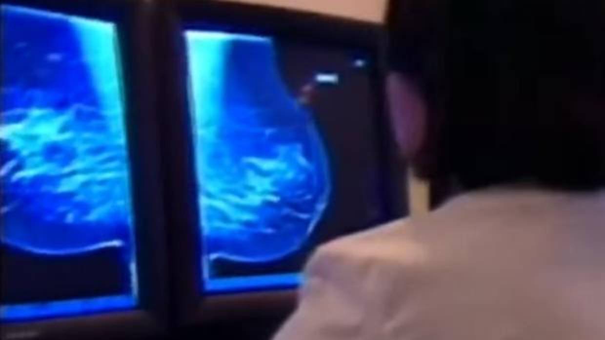 Una mujer será indemnizada al perder un pecho por un incorrecto diagnóstico de cáncer