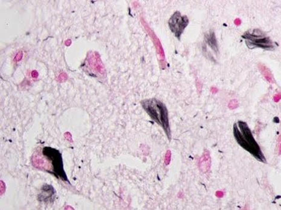 Ovillos neurofibriilares de proteína tau en el hipocampo de un paciente con alzhéimer
