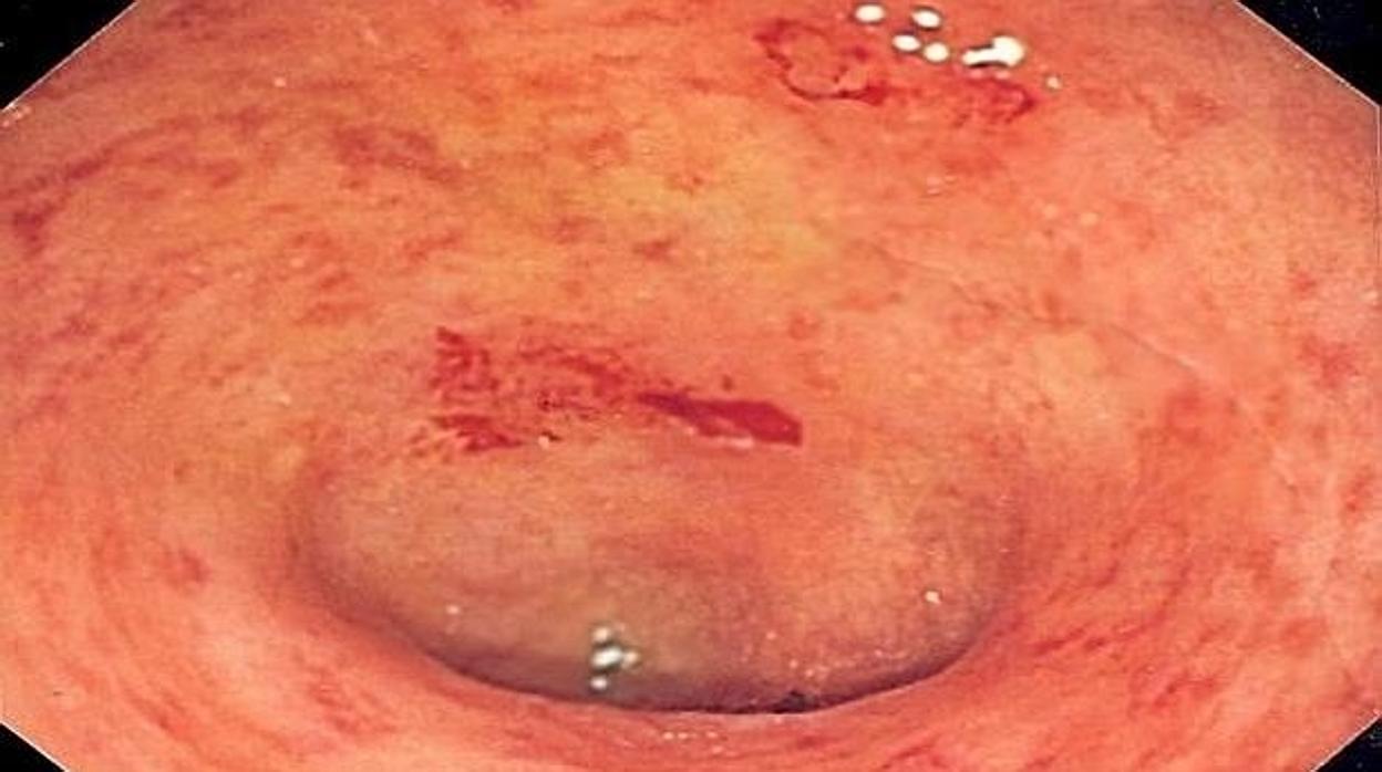 Imagen de colitis ulcerosa