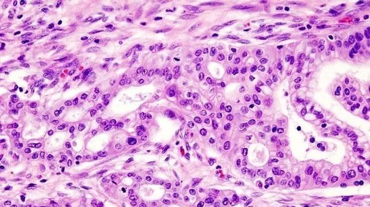 Imagen de un adenocarcinoma ductal de páncreas