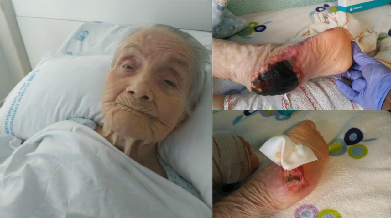 María Sánchez, de 94 años, ingresada en el hospital; a la dcha., las úlceras que sufre en sus talones