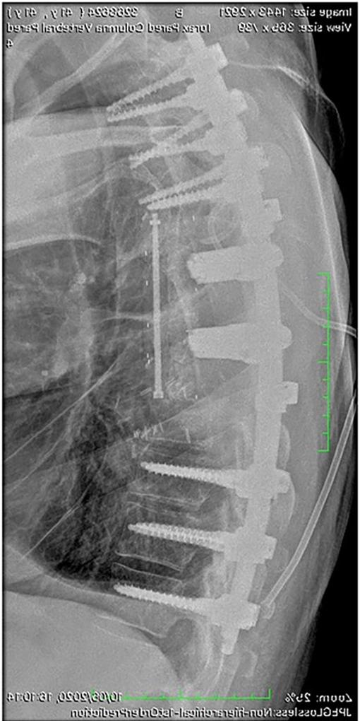 Radiografia con la reconstrucción de la columna con prótesis