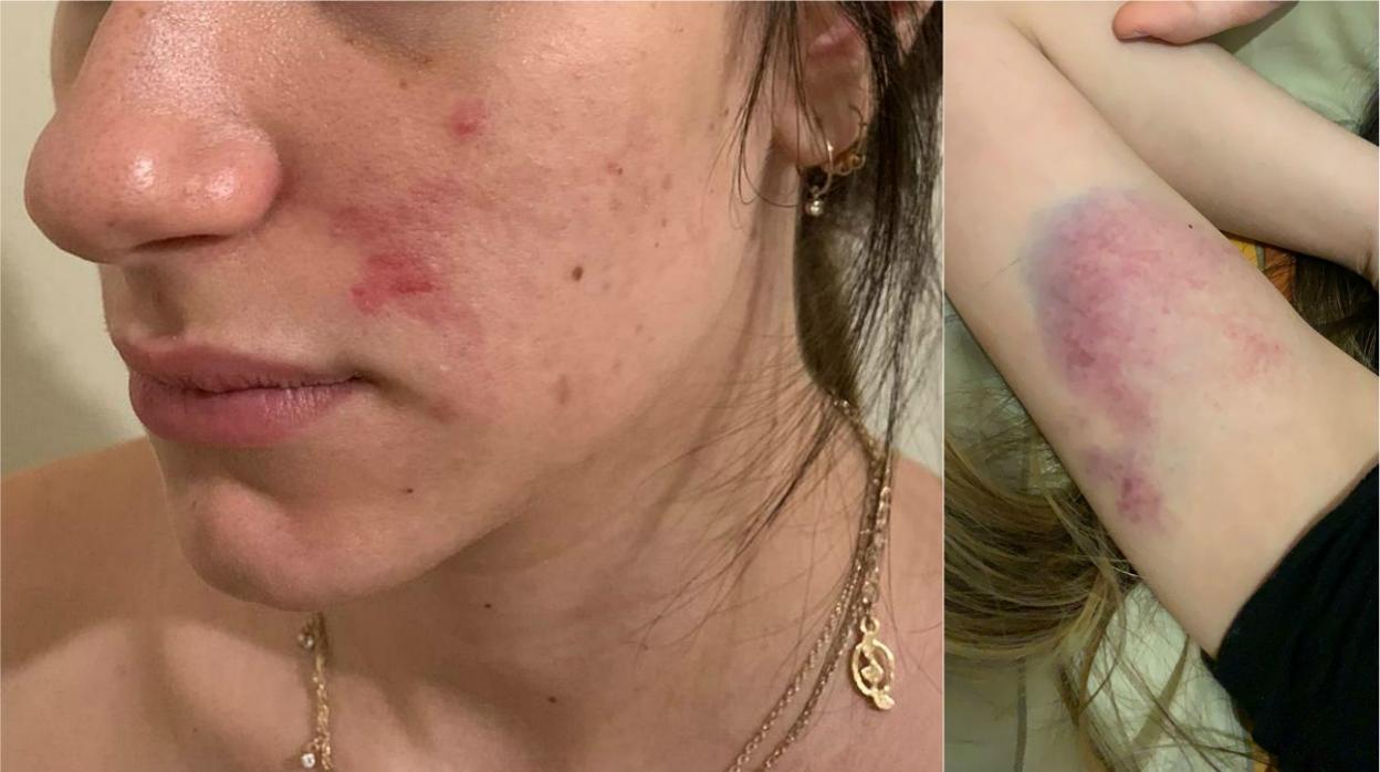 Isabella, venezolana de 23 años, con marcas en la cara por los golpes