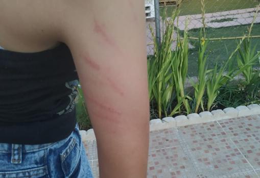 Algunos de los arañazos que tenía en el cuerpo la joven por la agresión