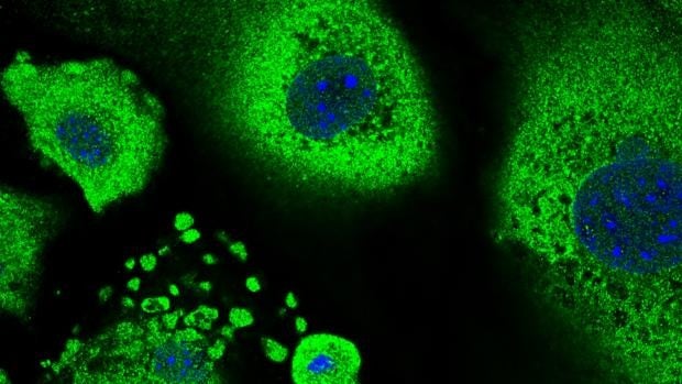 Descubren que una proteína que acelera el desarrollo del cáncer de piel también puede detenerlo