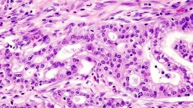 Científicos españoles ensayan un virus como nueva «herramienta terapéutica» contra el cáncer de páncreas