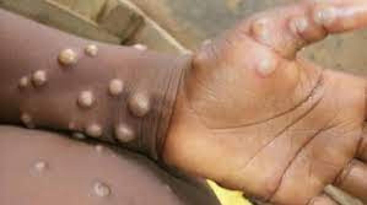 Pápulas, uno de las lesiones provocada por la viruela del mono