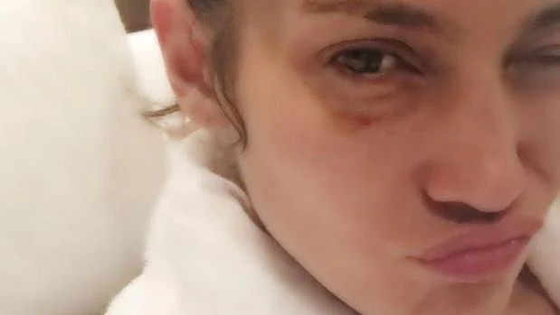 Instagram: Los motivos por los que Jennifer López tiene un ojo morado