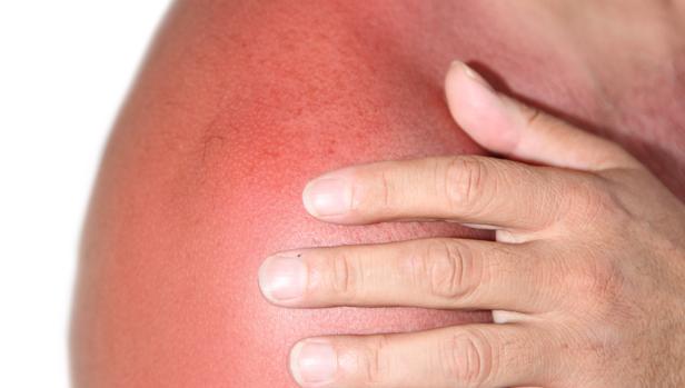¿Quemado por el sol? Diez respuestas a dudas frecuentes
