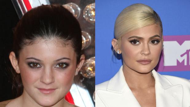 Kylie Jenner cuenta toda la verdad sobre sus operaciones estéticas