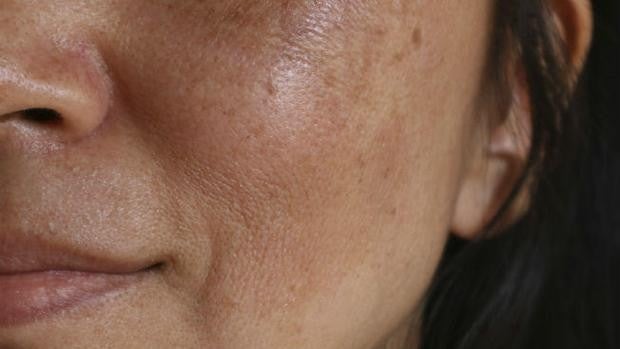 ¿Qué es el melasma facial y cómo combatirlo?