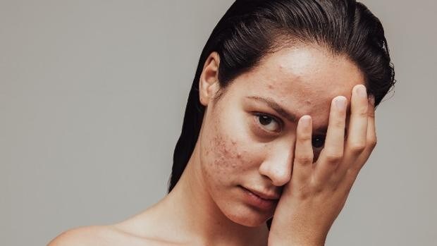 Qué es el acné cosmético, cómo evitarlo y paliarlo