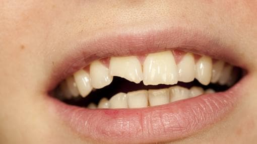 Nueve urgencias dentales muy comunes y cómo actuar hasta que vas al dentista
