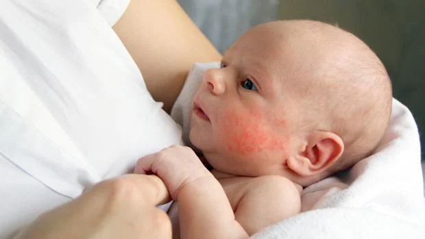 El virus del herpes labial puede producir secuelas neurológicas en los recién nacidos, de manera excepcional