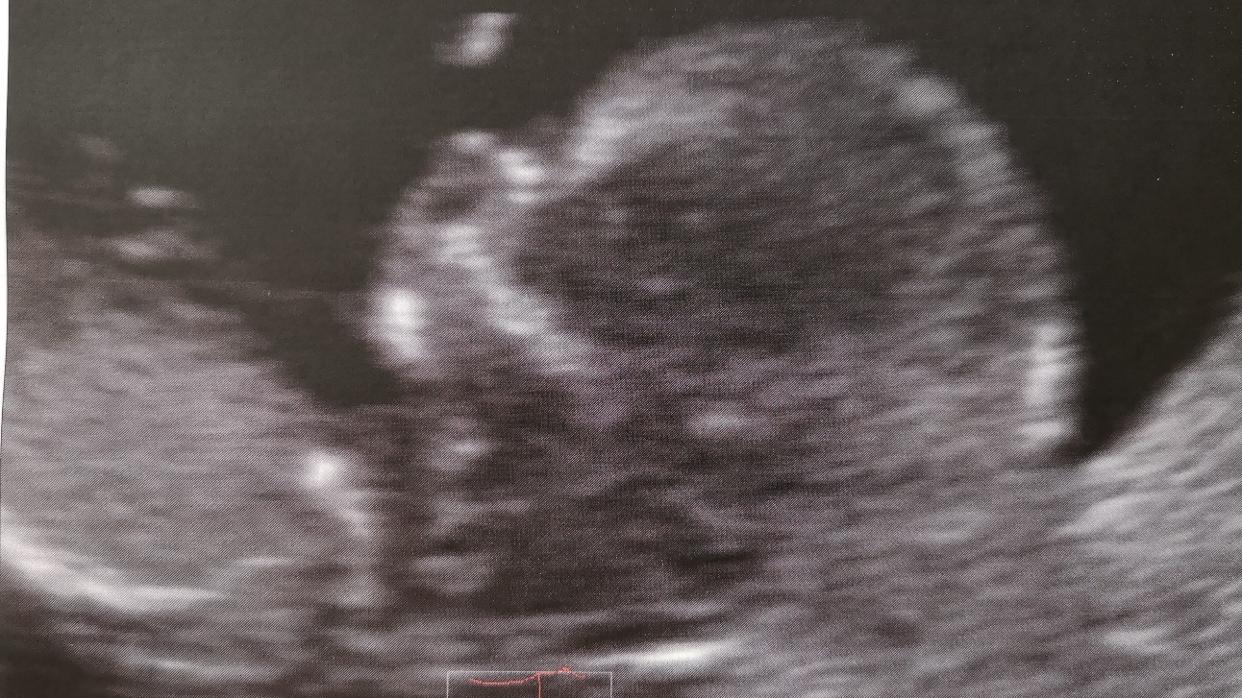 Semana 12 de embarazo: la cara está prácticamente formada