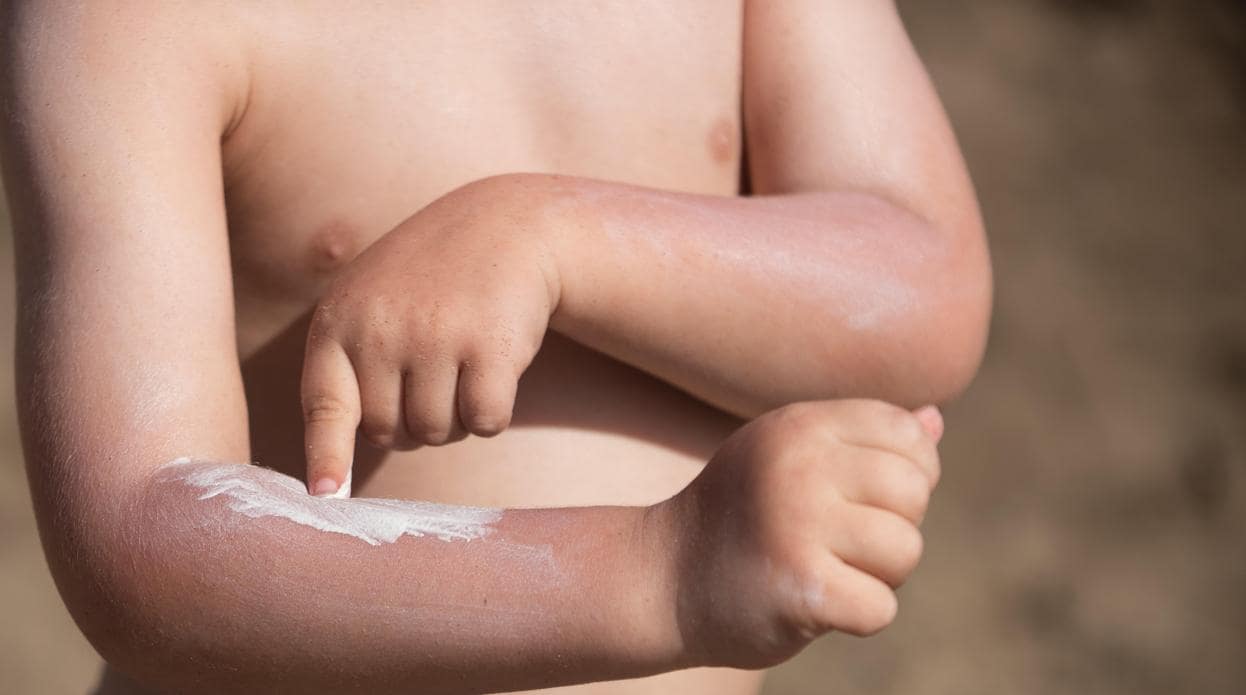 La piel tiene memoria: sufrir 5 quemaduras en la infancia aumenta el riesgo de cáncer