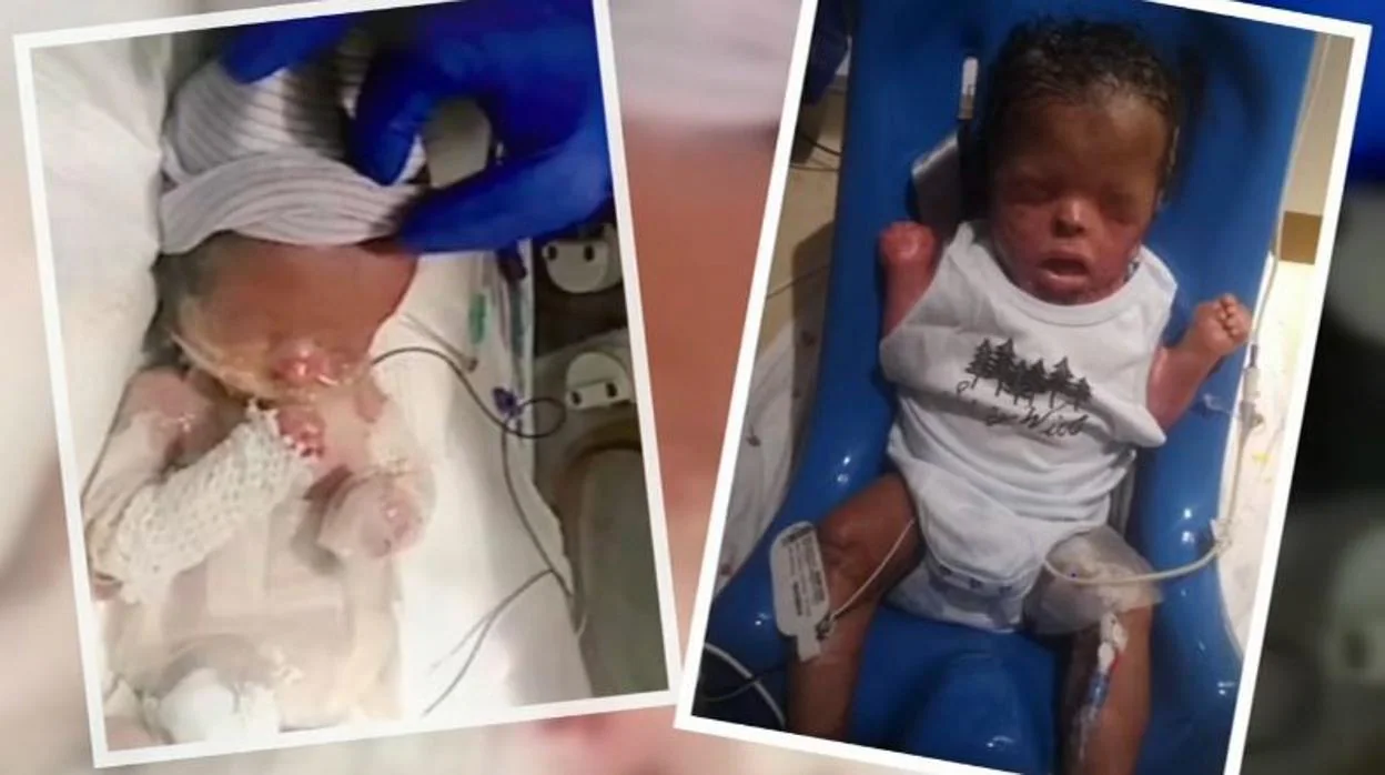 La historia del bebé que nació sin piel y no pudo ser abrazado por su madre hasta los 10 meses