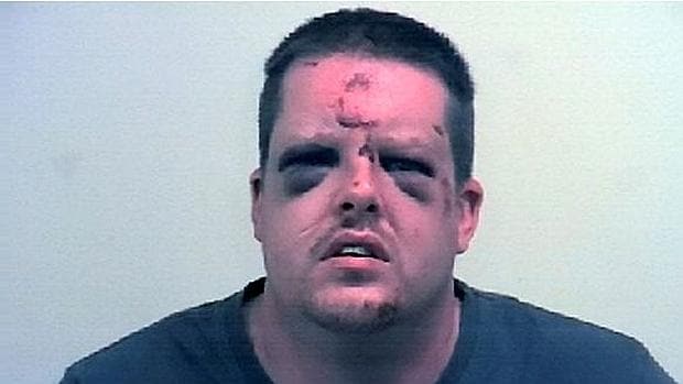 El agresor tras haber sido golpeado y mordido por su víctima