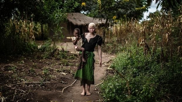 Foto de recurso: Los ataques contra albinos, a los que se atribuyen poderes mágicos, han aumentado