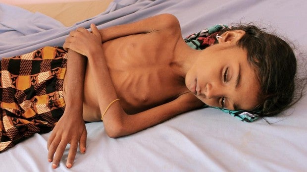 La vida de los niños en Yemen se agota por la malnutrición