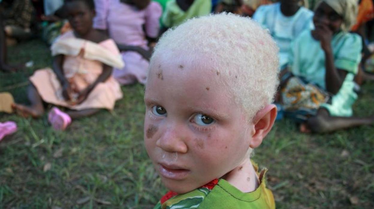 Los niños albinos son perseguidos en Tanzania