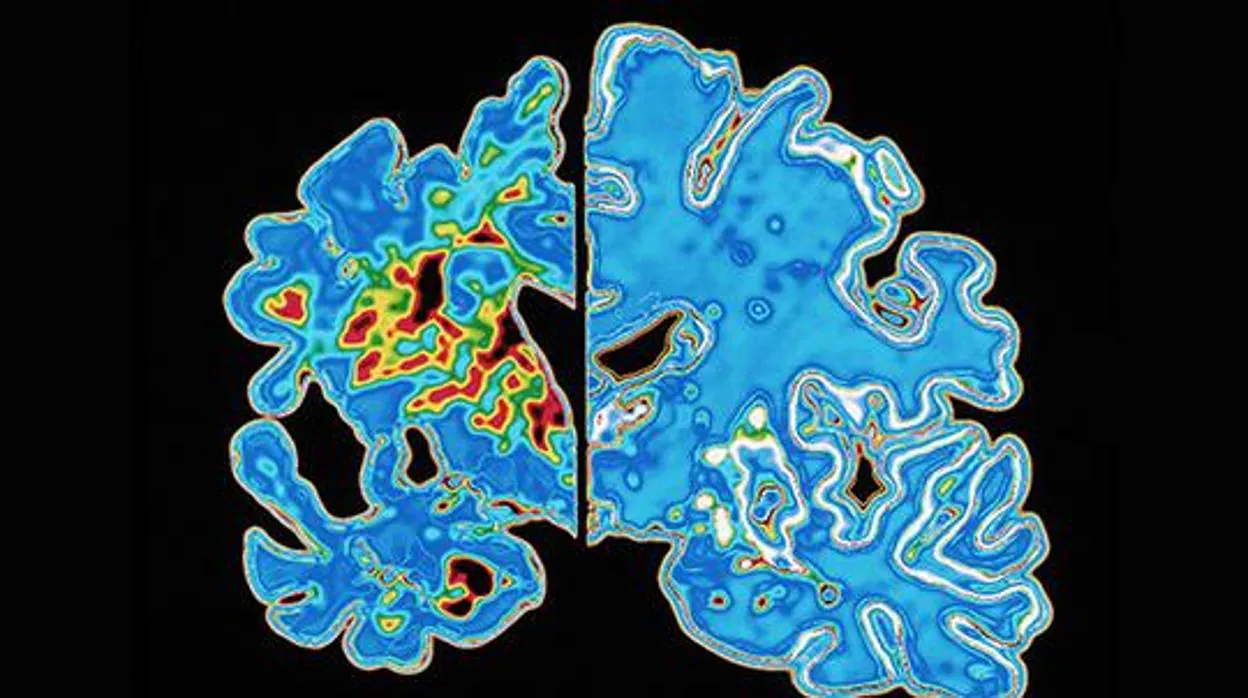 Sacaner de un cerebro con Alzhéimer