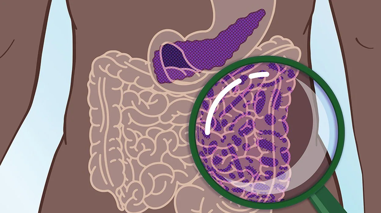 El 80% de los casos de cáncer de páncreas se diagnostican en un estado avanzado
