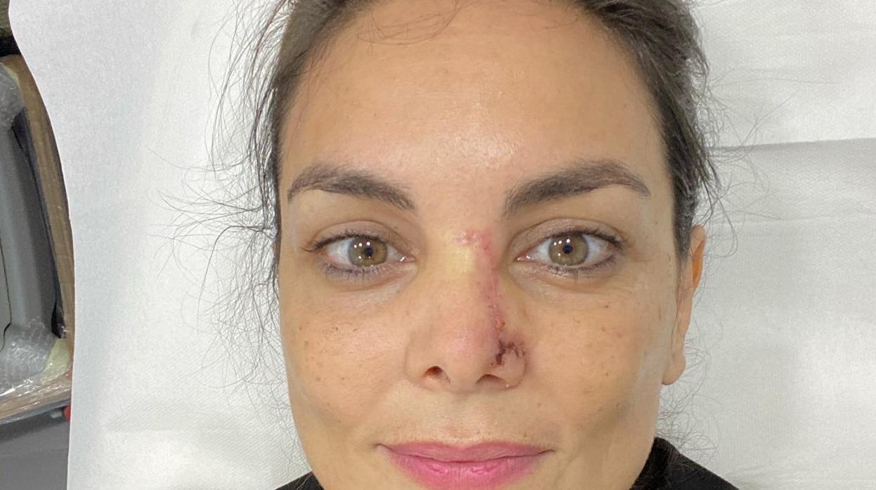 Mónica Carrillo muestra la cicatriz en su cara tras la extirpación del carcinoma