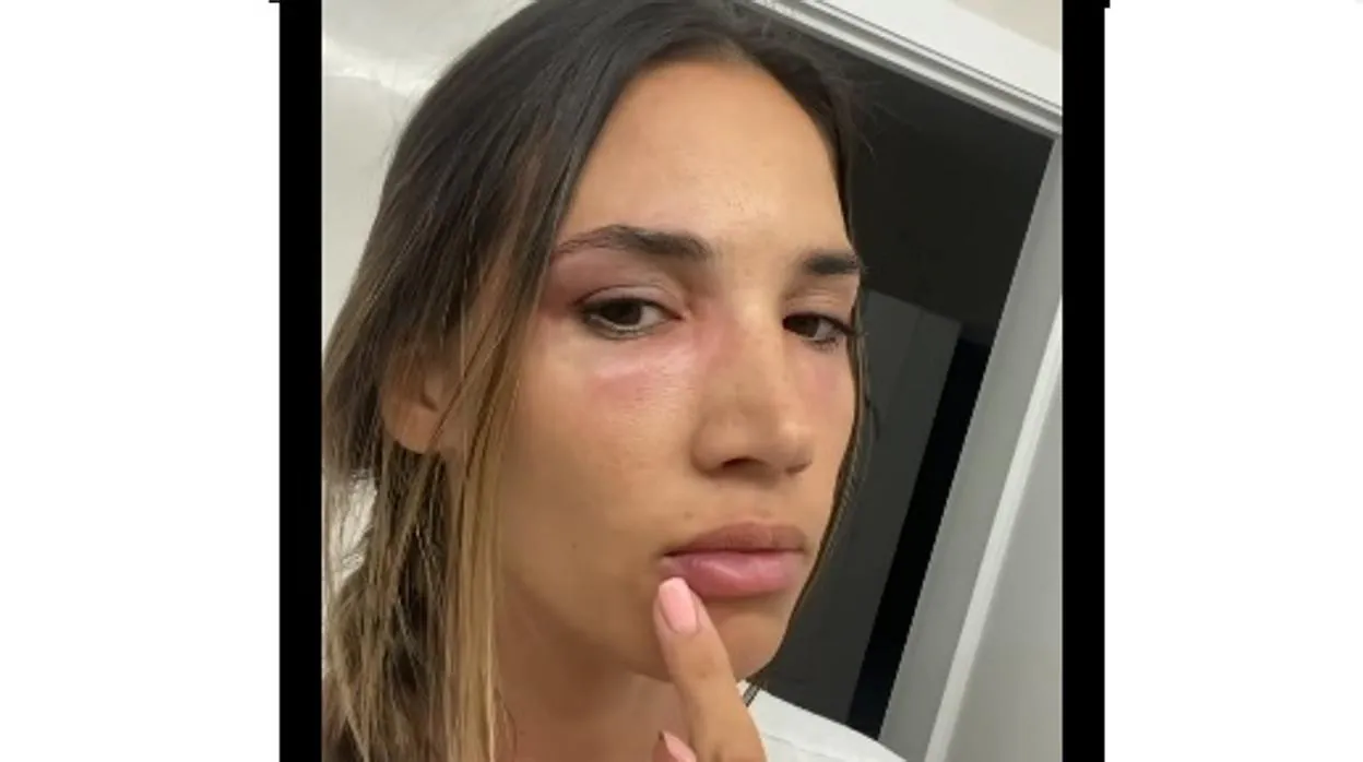Susto de India Martínez por una alergia que le deja la cara desfigurada