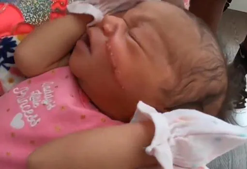 Un bebé recibe 13 puntos tras sufrir un gran corte en la cara al nacer por cesárea