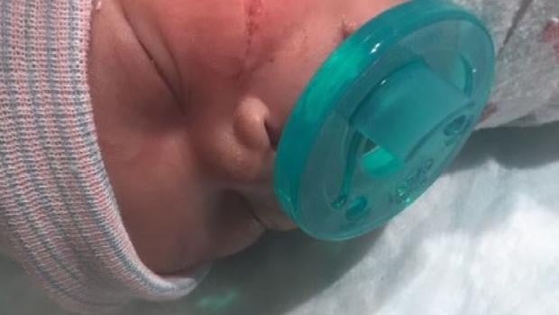 Un bebé recibe 13 puntos tras sufrir un gran corte en la cara al nacer por cesárea