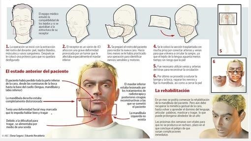 Reconstrucción de la intervención