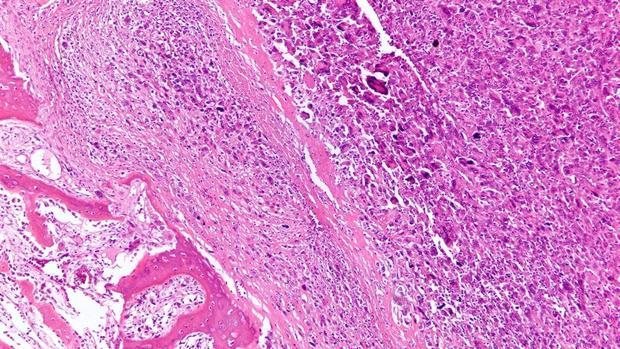 Imagen de células de osteosarcoma