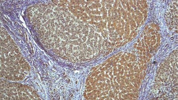 Muestra de tejido de un hígado humano con cirrosis donde se observan cambios en la estructura y una elevada expresión de la proteína CPEB4 en los nódulos de regeneración