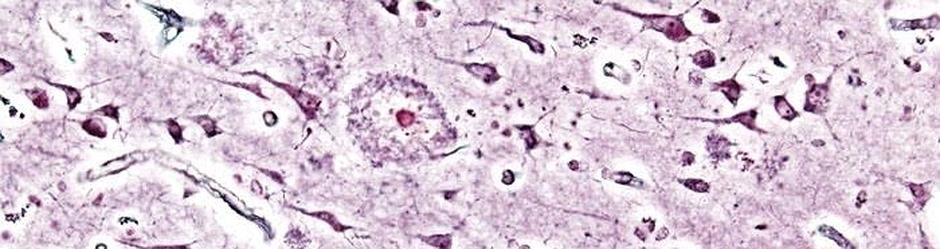 Placas de beta-amiloide en el cerebro de un paciente con alzhéimer