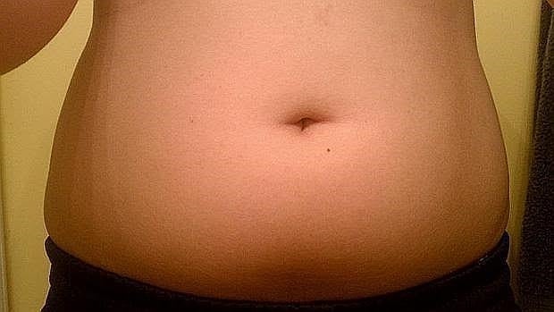 La cirugía bariátrica también es beneficiosa en los adolescentes obesos