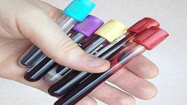 Un test de sangre puede ser suficiente para saber qué pacientes responderán al tratamiento