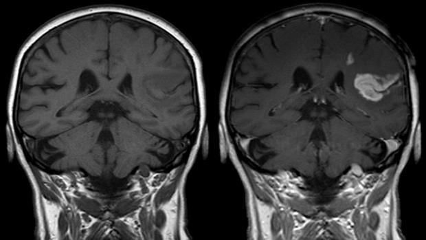 Demuestran que la terapia con células madre es muy eficaz y segura en el tratamiento del ictus
