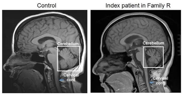 Anomalías en el cerebelo y la médula espina en un paciente con ataxia (izquierda)