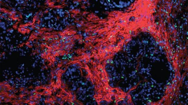 Una triple terapia logra aumentar la supervivencia en el cáncer de páncreas